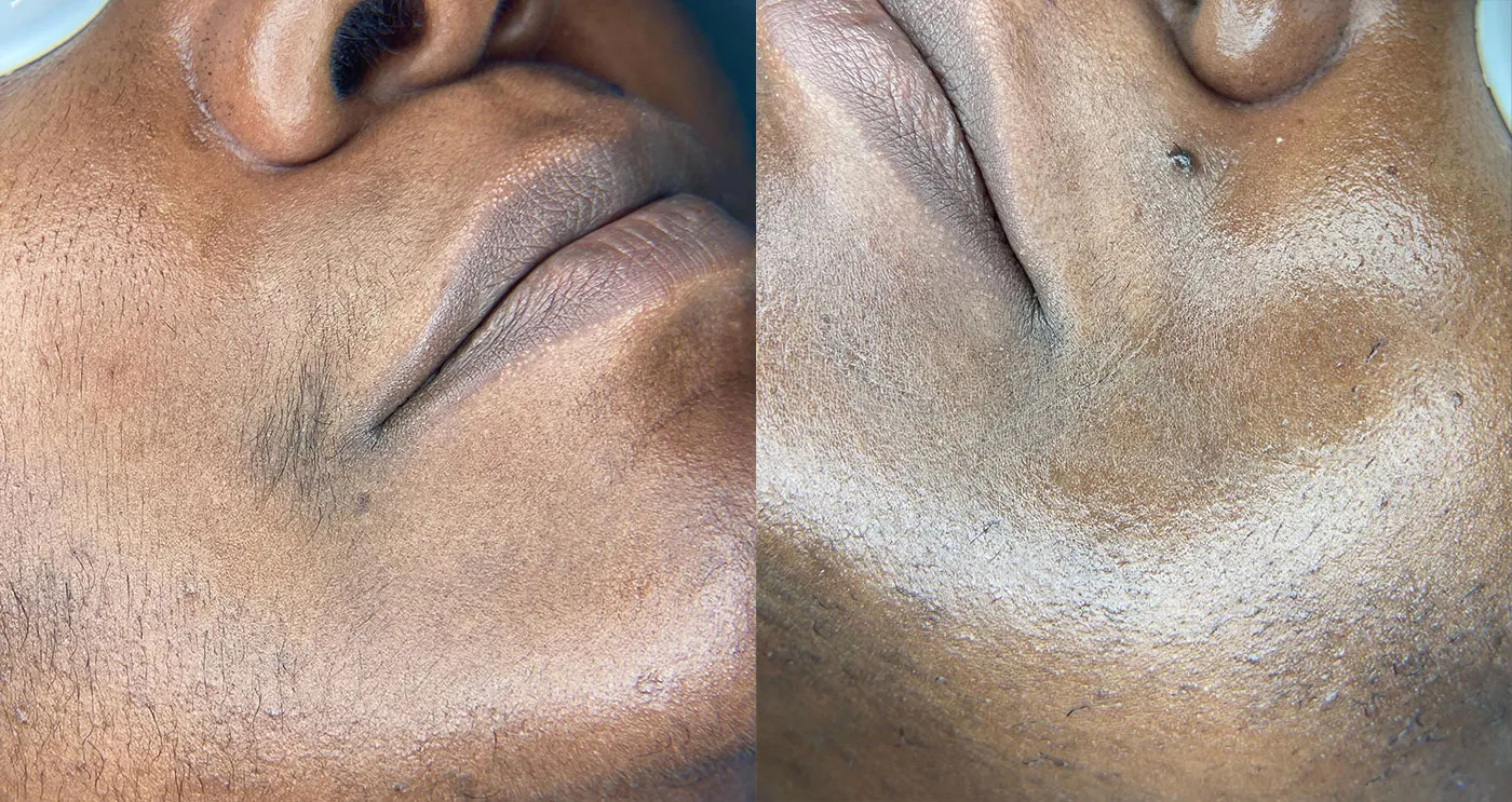 Hair Removal before & after on persons jaw line & mouth