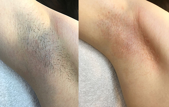 Hair Removal before & after on persons armpit