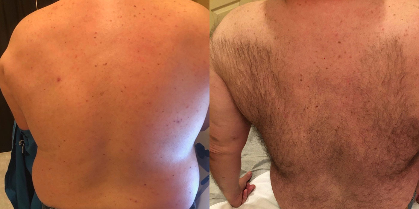Before & after hair removal for males back