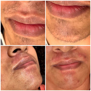 Hair Removal before & after around persons mouth & face