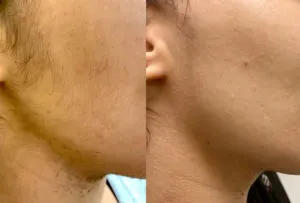 Hair Removal before & after on persons jaw line