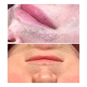 Hair Removal before & after on persons mouth & face